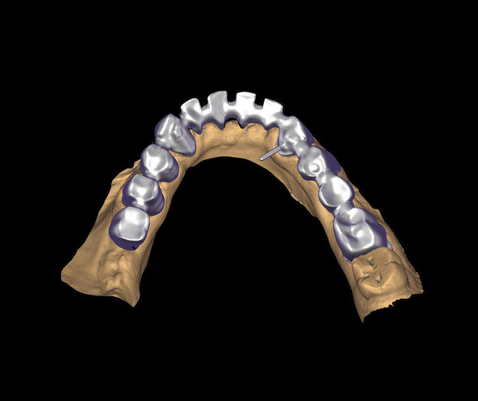 Progettazione digitale CAD di un'arcata dentale
