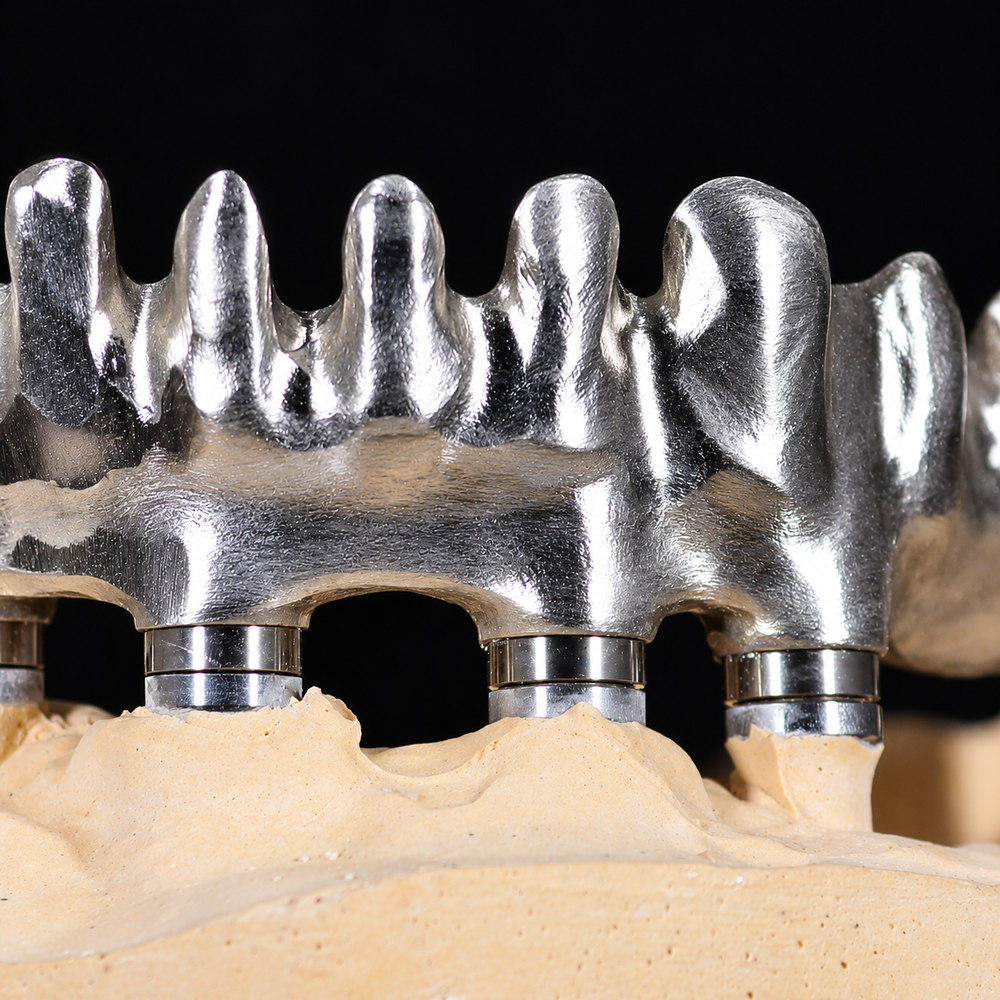 Struttura metallica implantare realizzata con flusso digitale