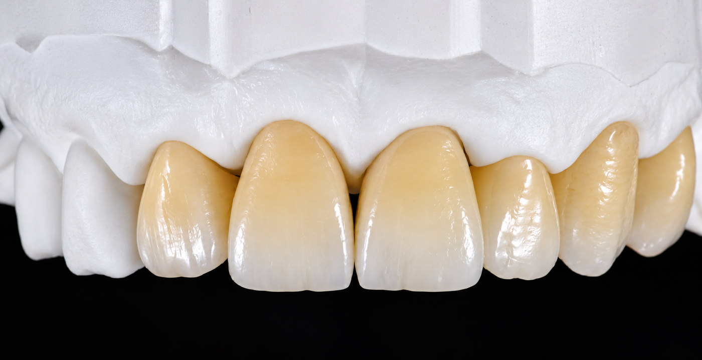 Corone dentali rifinite su modello