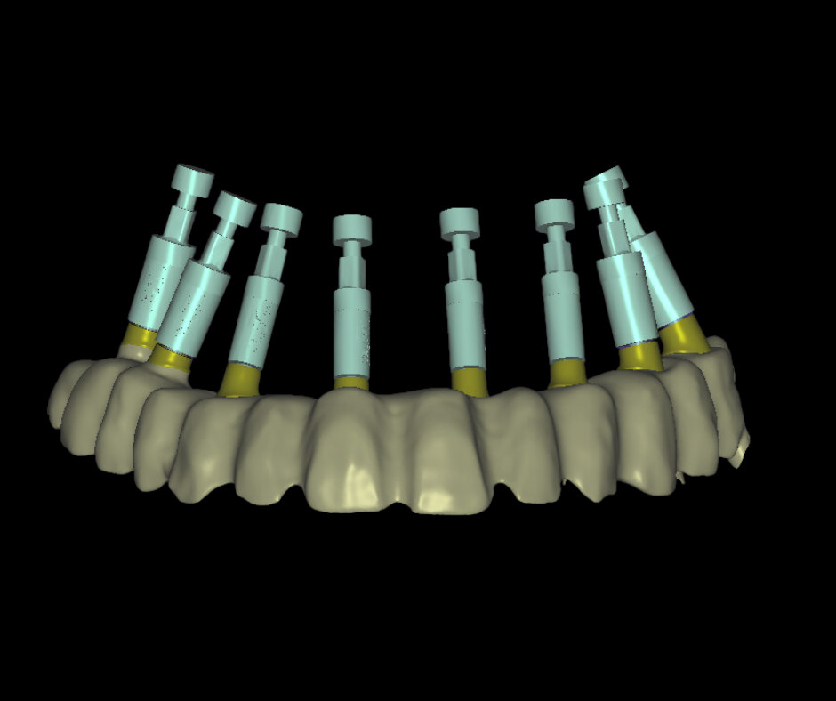 Struttura protesica implantare con componenti avvitate