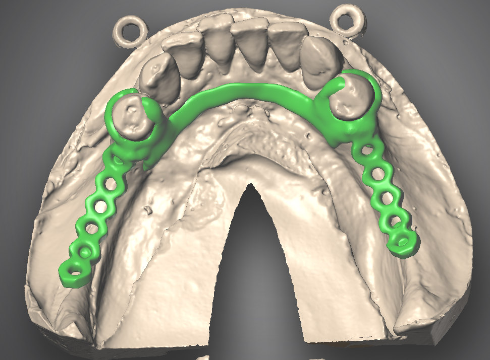 Struttura scheletrata digitale su modello dell'arcata superiore